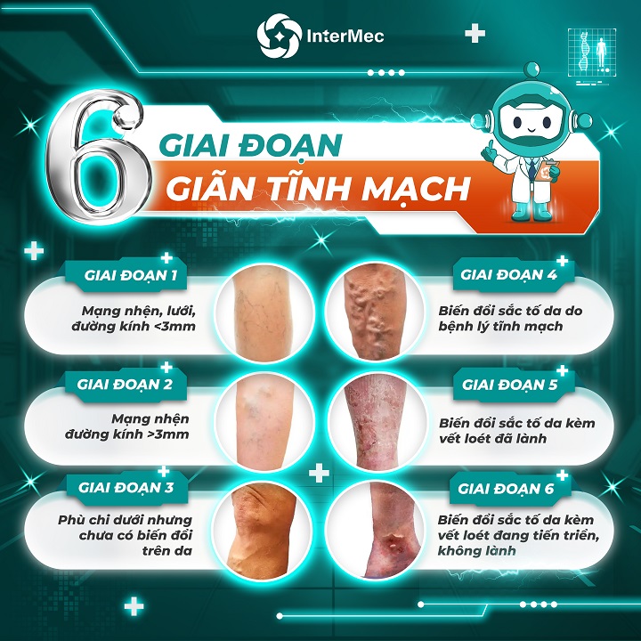 Các giai đoạn suy giãn tĩnh mạch
