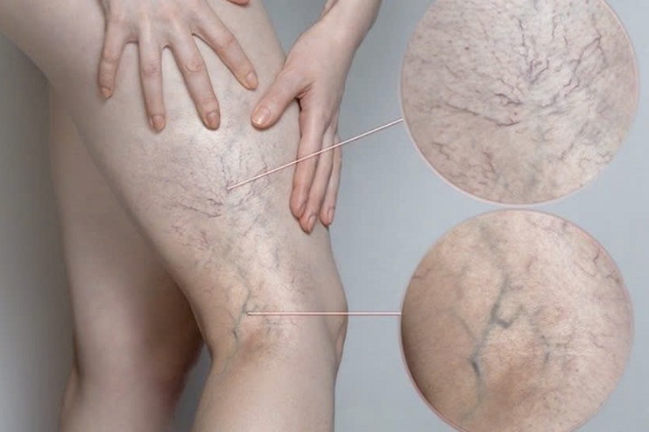 suy giãn tĩnh mạch