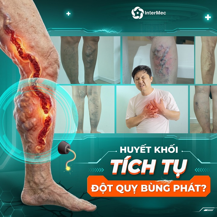 huyết khối tĩnh mạch
