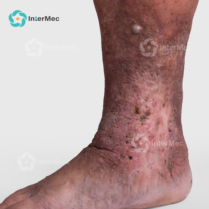 Biến chứng giãn tĩnh mạch