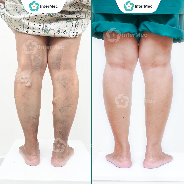 điều trị giãn tĩnh mạch