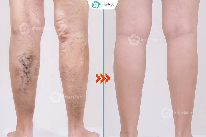 kết quả điều trị