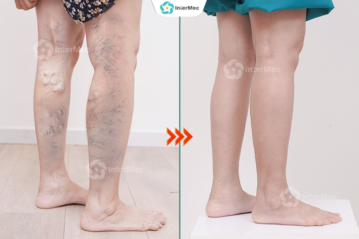 kết quả điều trị