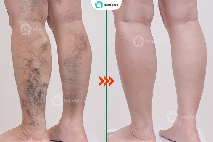 kết quả điều trị